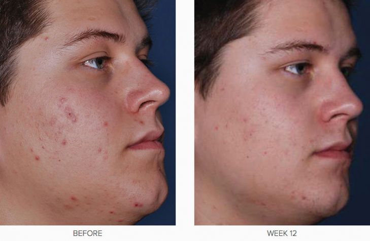 CLENZIderm M.D. Before &​ After