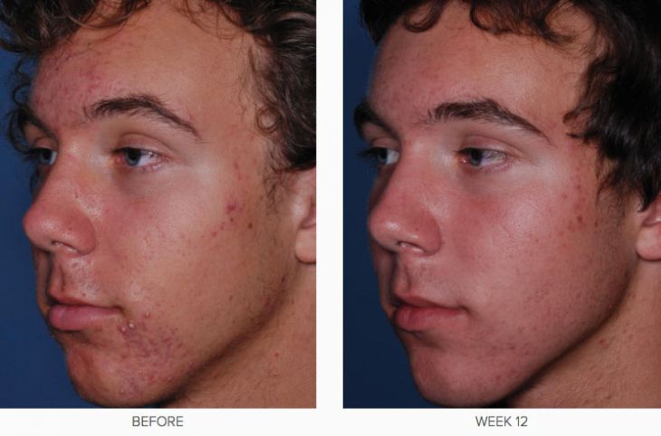 CLENZIderm M.D. Before &​ After