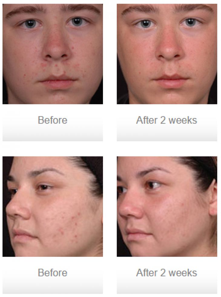 Acne Treatment | Diamond Aesthetics