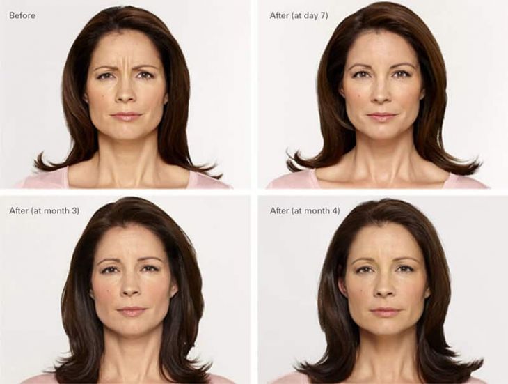 Botox before and after treatment