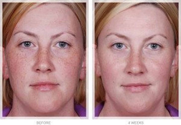 Melasma and Pigmentation Treatment before and after