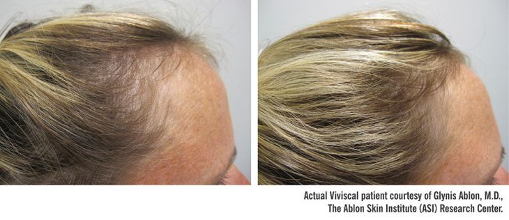 Viviscal Professional Before and After Treatment
