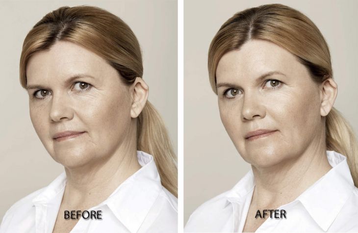 ba Restylane Skin Boosters before and after treatment