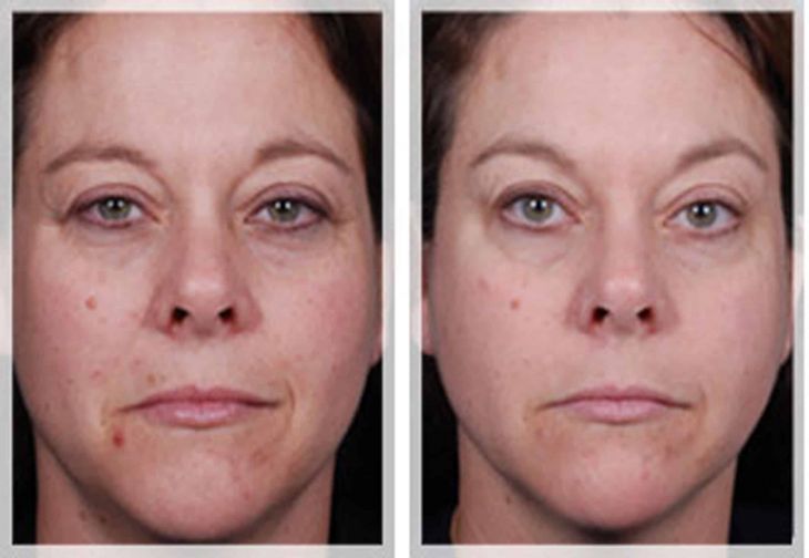 Melasma and Pigmentation Treatment before and after