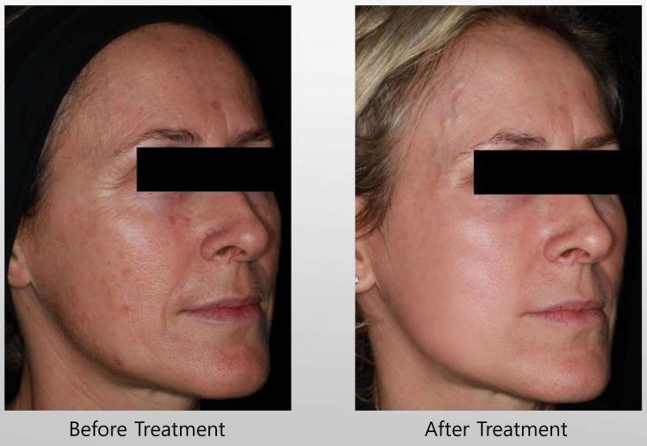 Before and After Infini treatment