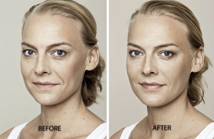 Restylance Skin Booster before and after treatment