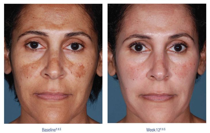 Nu Derm Before and After