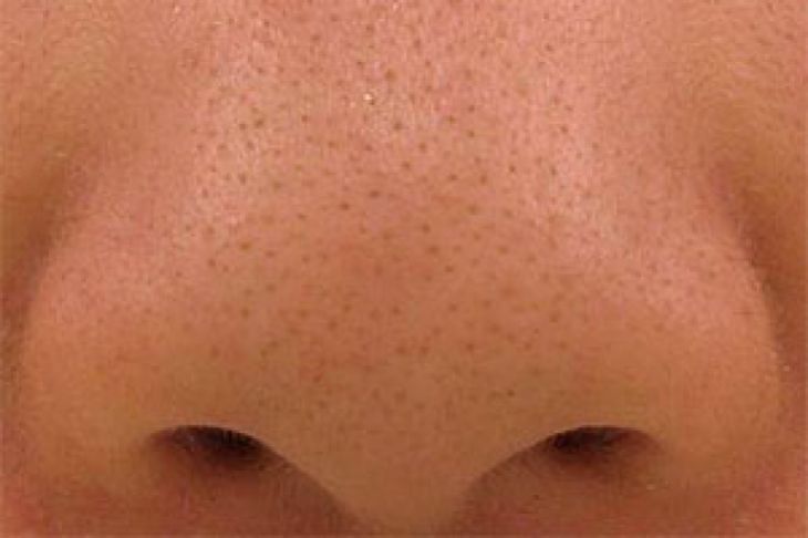 Enlarged Pores